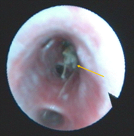 Bronchial Foreign Body
